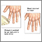 Capillary nail refill test
