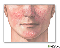 acne medlineplus treatment causes pimples gov nih nlm skin whiteheads facial illustration zits pimple blackheads condition