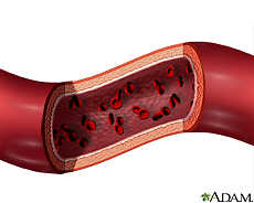 vasculitis angiogram
