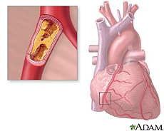 Ilustración del corazón con un bloqueo de placa en la arteria coronaria (aterosclerosis)