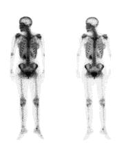 Fotografía de un rastreo óseo de dos personas