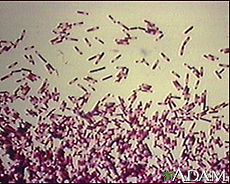 Clostridium Difficile Infections: MedlinePlus