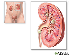 kidneystones What Are Kidney Stones From