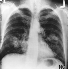 Radiografía pulmonar mostrando un crecimiento en el pulmón izquierdo pudiendo ser cáncer