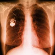 Fotografía de una radiografía del pecho mostrando un marcapasos