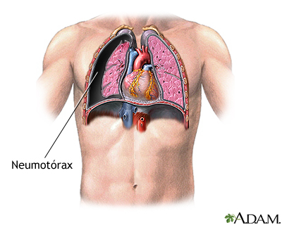 neumotórax