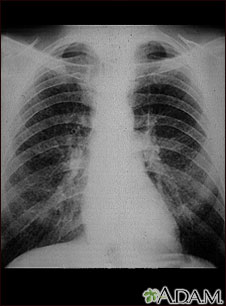 Pulmones de un trabajador del carbón; rayos X