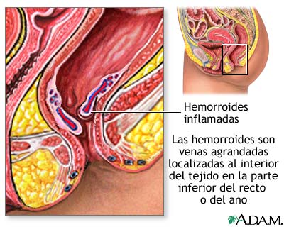 principios de hemorroides. Hemorroides