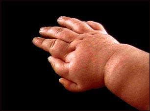 Polidactilia en la mano de un niño