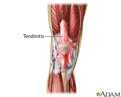 Dolor en la rodilla causado por una tendinitis