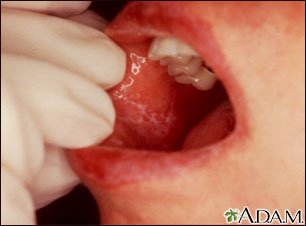 La Mucosa Oral 16