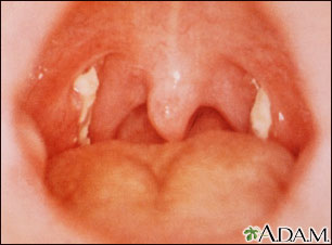 Mononucleosis: vista de la garganta