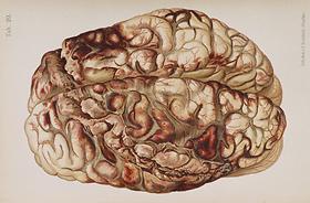 Encircling Gunshot-wound in Brain, 1898