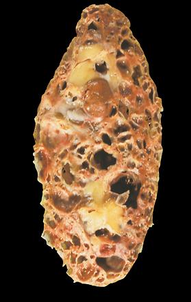 Polycystic Kidney crossection