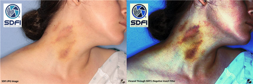 Side by side view of bruises on a White woman’s neck,  showing normal view, and alternate view.