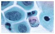 Precancerous cervical cells