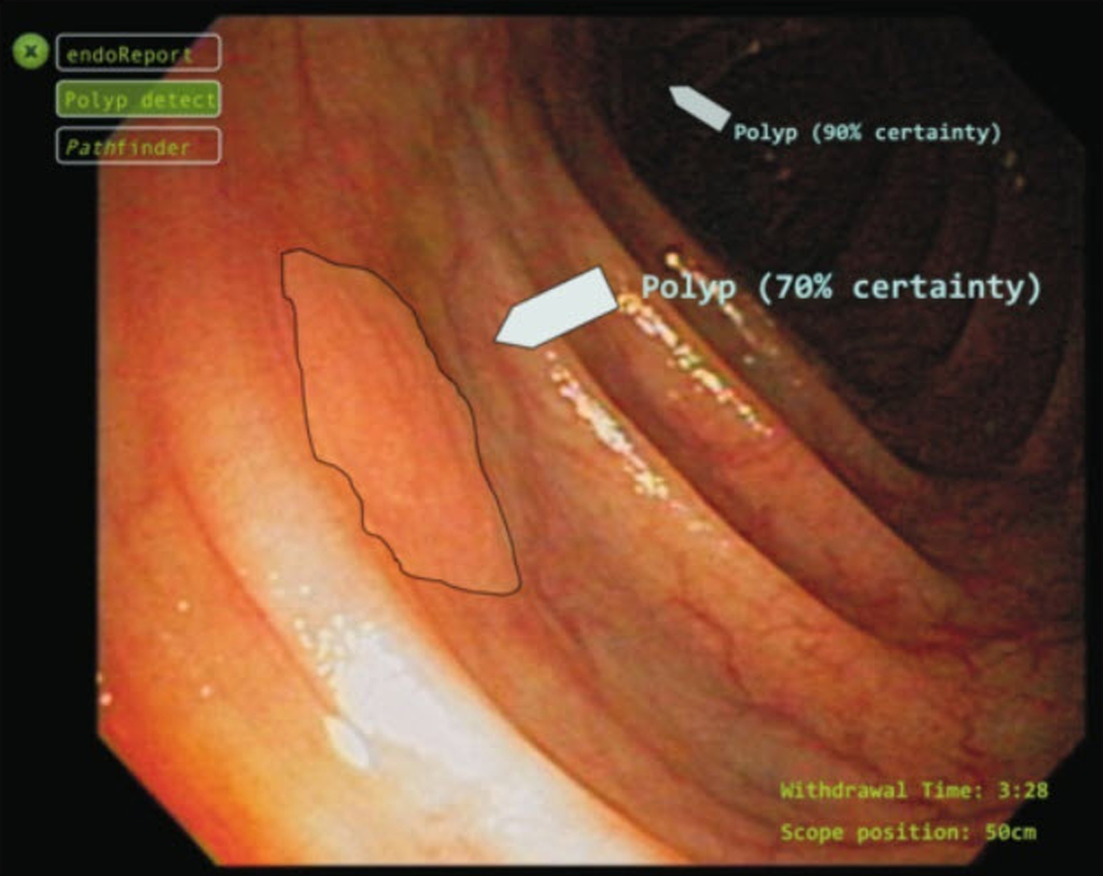 Scope image of a colon with polyps pointed out
