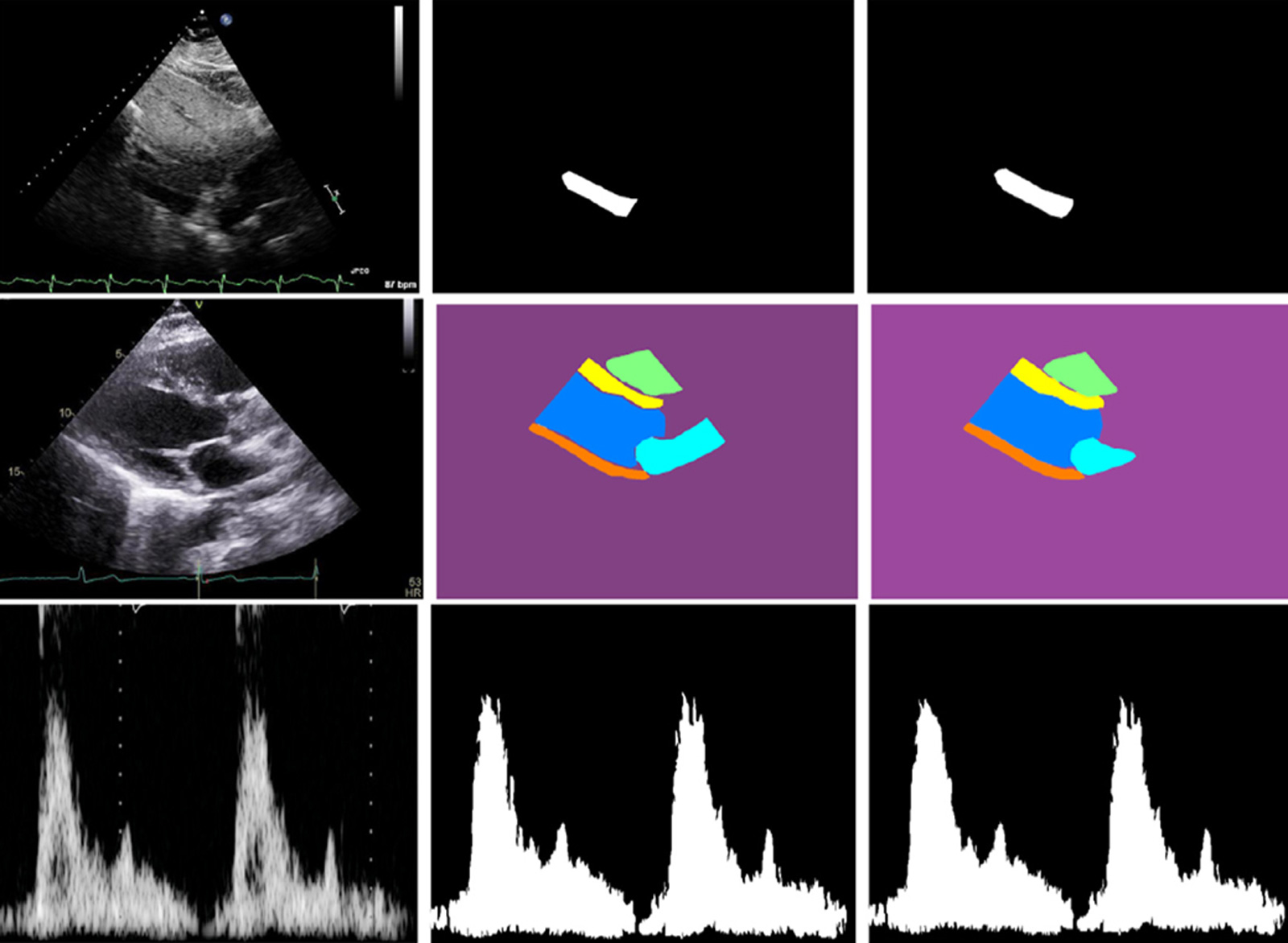 Diagram showing ultrasound images of a heart and charting heartbeat