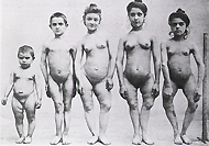 Five children with rickets, from a family of eight, a full length frontal view showing deformed legs. Illustrated in Nouvelles iconographie de la salpetrière, v. 14, p. 299-304. Paris, 1900. Image A012427 from Images from the History of Medicine