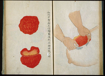 Two pages show the removal of tumor tissue from a patient's breast (right) and the pathological specimen (left). This manuscript describes the surgical procedures of the Hanaoka school, which used Chinese herbs as a general anesthetic.