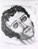 An illustration of the right side, full face view of male patient with cholera on a pillow.