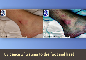 Side by side view of injured foot showing normal view, and alternate view.