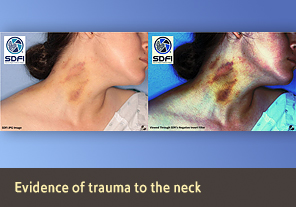 Side by side view of bruises on a White woman’s neck,  showing normal view, and alternate view.