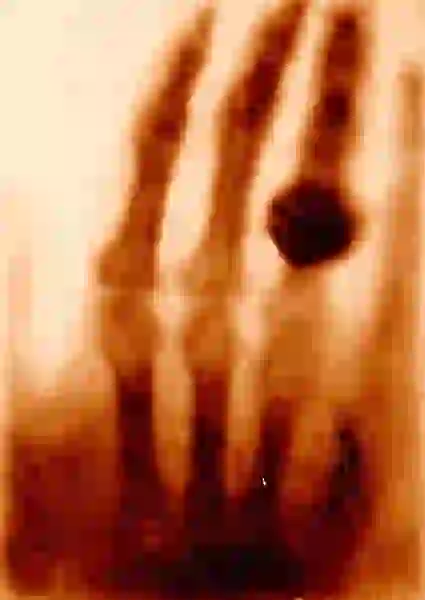 A blurry x-ray of four fingers, one of them with a large ring. 