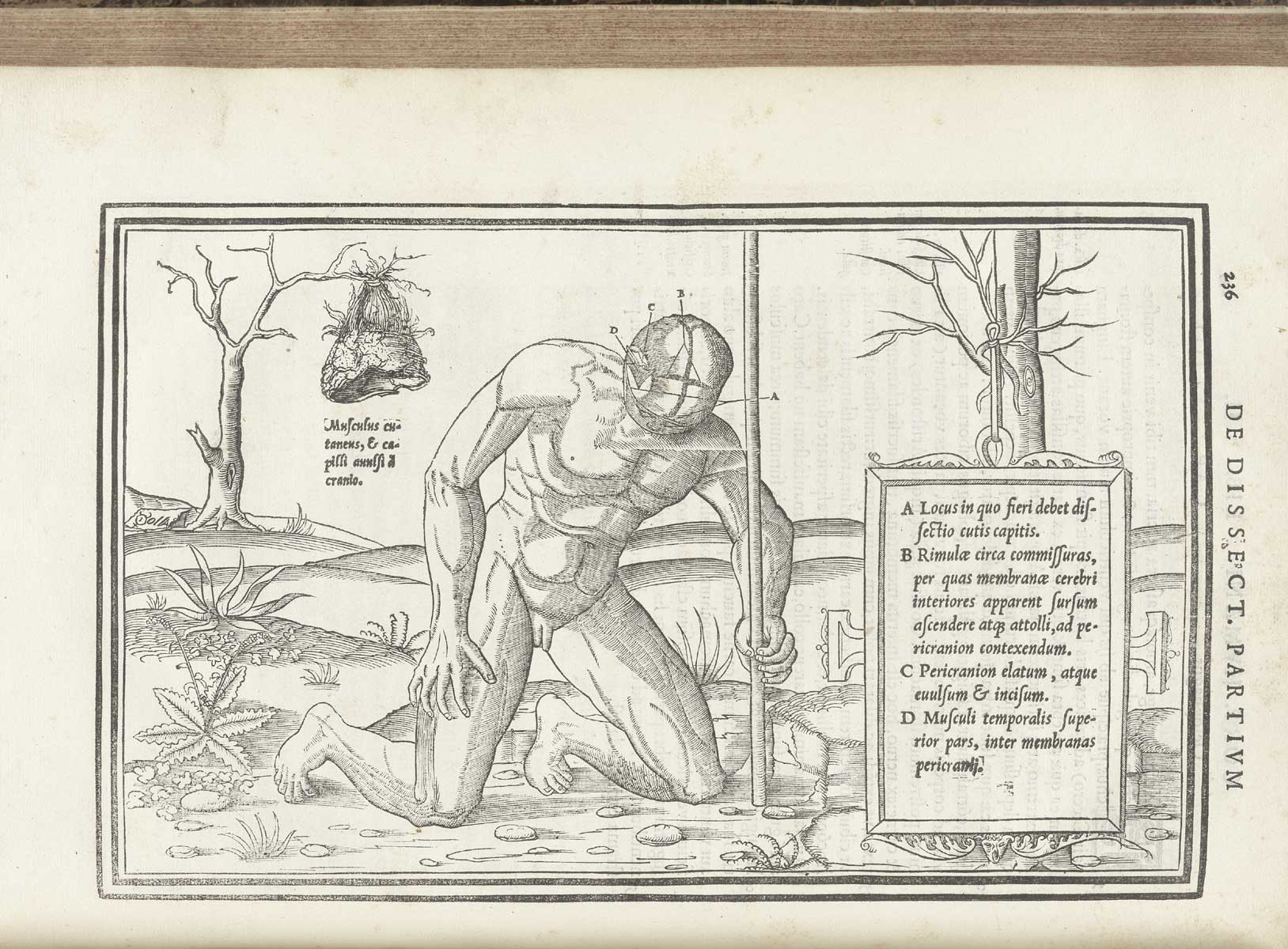 Woodcut of nude male figure in a pastoral setting on his knees propping himself up with a wooden staff using his left hand, facing downward giving a view of the top of his head with scalp removed to show the sutures of the skull, while in the background to the left hangs his scalp from the branch of a naked tree by the hair; on the right is a tablet naming the structures in Latin; from Charles Estienne’s De dissection partium corporis humani libri tres, NLM Call no.: WZ 240 E81dd 1545.