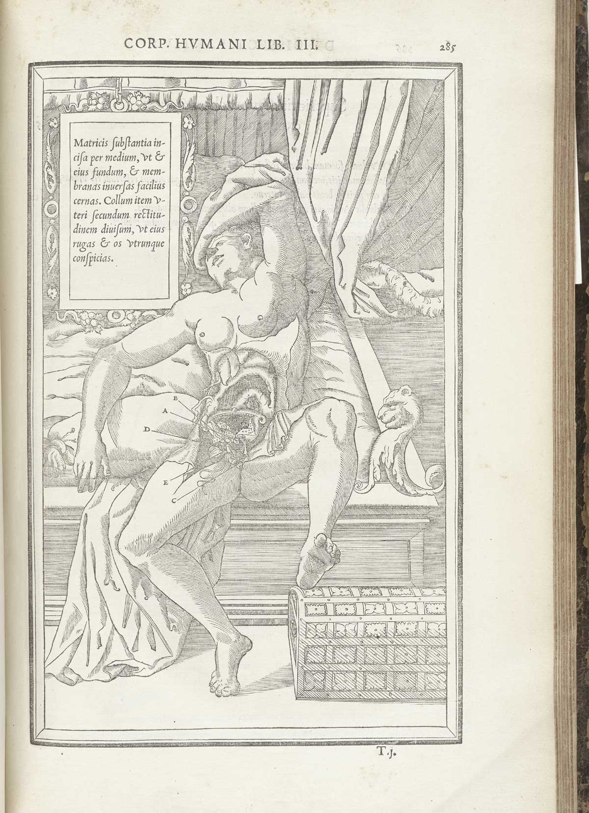 Woodcut of a female figure laying back on a bed with layers of flesh removed from the abdomen to reveal the uterus, cervix, and other reproductive organs; the woman has flowing hair and is facing upward, with her left arm wrapped around her forehead in a modest pose; a tablet giving text in Latin about the indicated body parts hangs above and to the left of the figure; from Charles Estienne’s De dissection partium corporis humani libri tres, NLM Call no.: WZ 240 E81dd 1545.