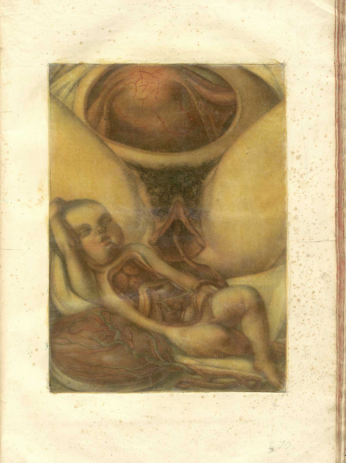 Color mezzotint of a newborn baby just outside its mother’s labia with umbilical cord still attached and running up the vagina; the baby has its flesh removed from its torso and abdomen to reveal its internal organs, and the placenta lies under his right elbow; from Jacques Fabian Gautier d’Agoty’s Anatomie générale des viscères en situation, NLM Call no.: WZ 260 G283c 1745.