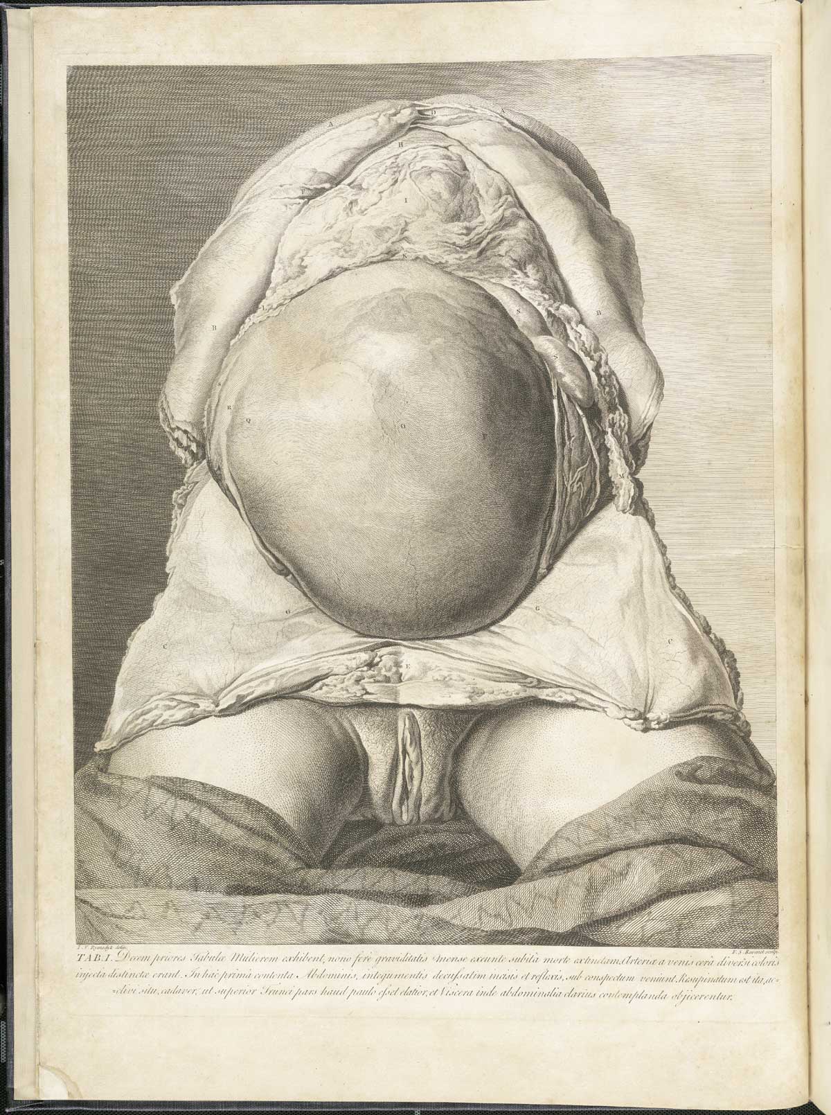 Table 1 of William Hunter's Anatomia uteri humani gravidi tabulis illustrata, featuring the frontal view of female dissected to expose the gravid uterus.