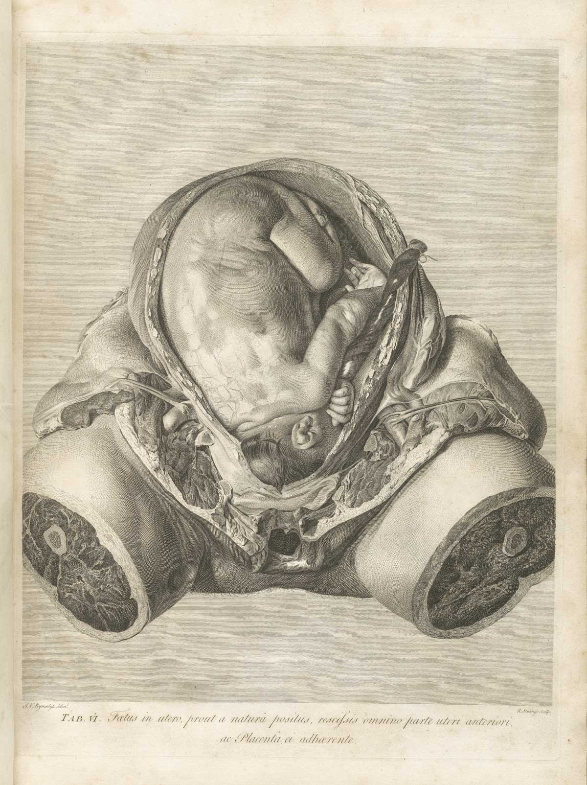 Table 6 of William Hunter's Anatomia uteri humani gravidi tabulis illustrata, featuring the frontal view of female dissected to expose a fetus within the gravid uterus.