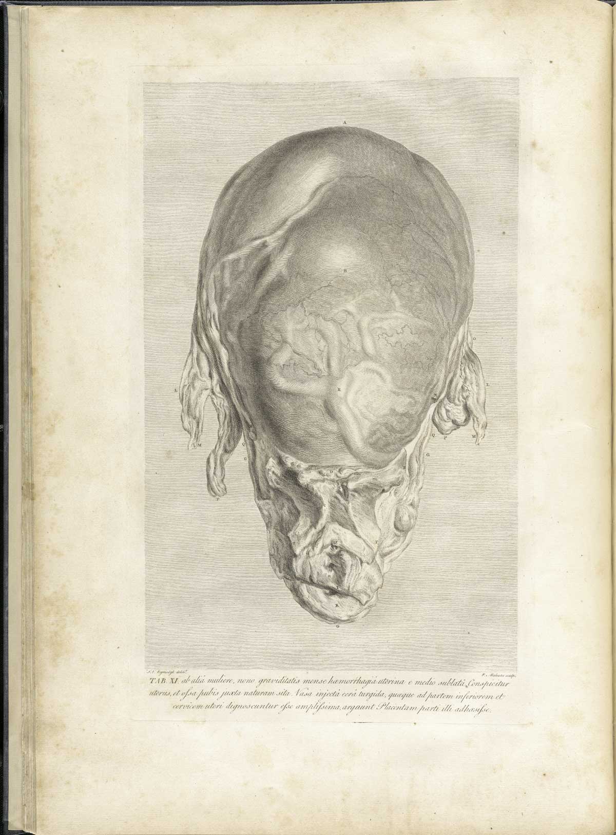 Table 11 of William Hunter's Anatomia uteri humani gravidi tabulis illustrata, featuring the left side view of female dissected with the uterus and birth canal exposed.