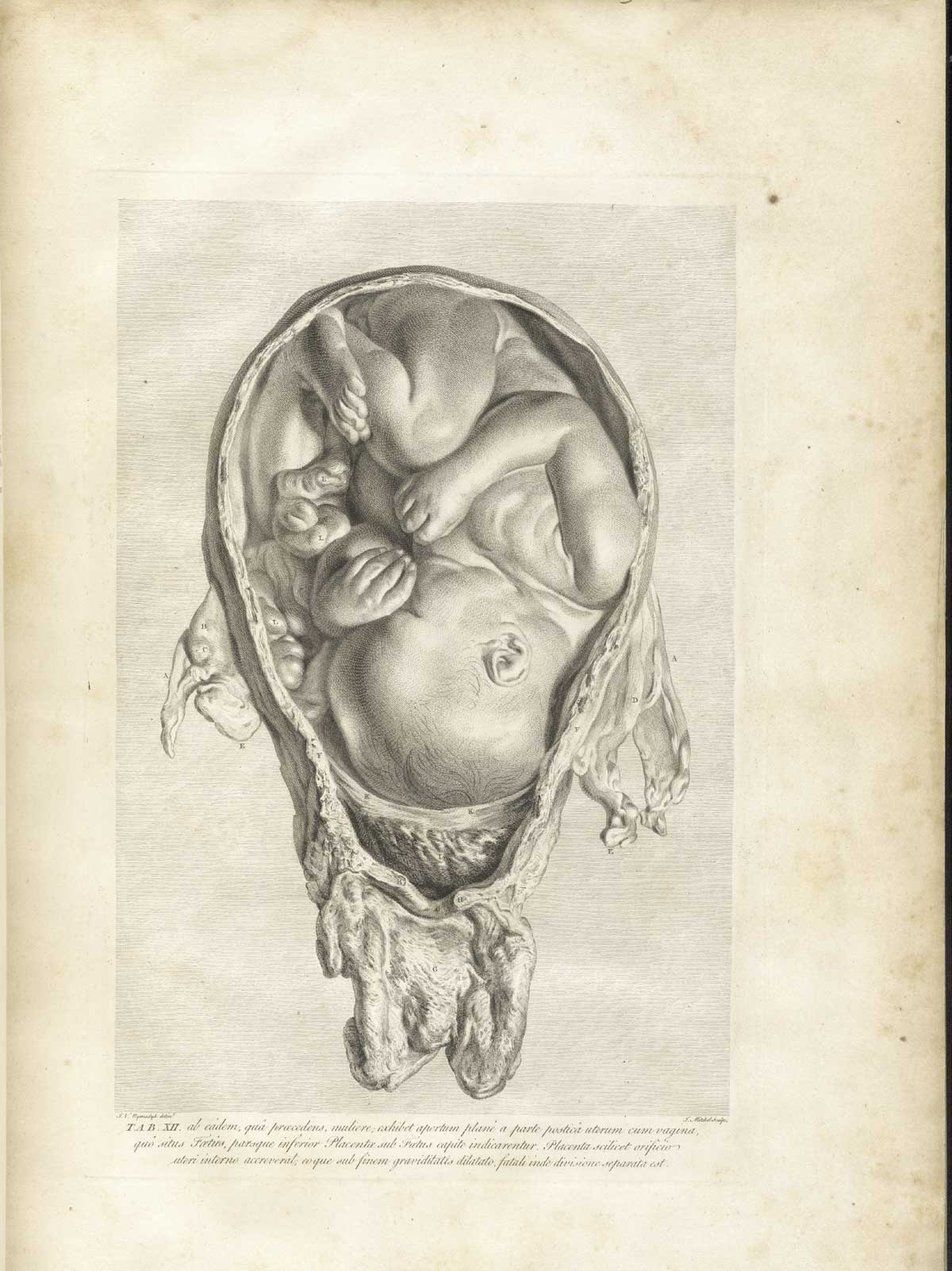 Table 12 of William Hunter's Anatomia uteri humani gravidi tabulis illustrata, featuring the cross section of a detached uterus with a fetus inside.