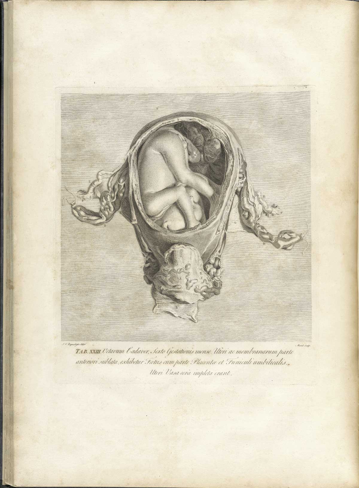 Table 23 of William Hunter's Anatomia uteri humani gravidi tabulis illustrata, featuring the cross section of a detached uterus with a fetus inside.