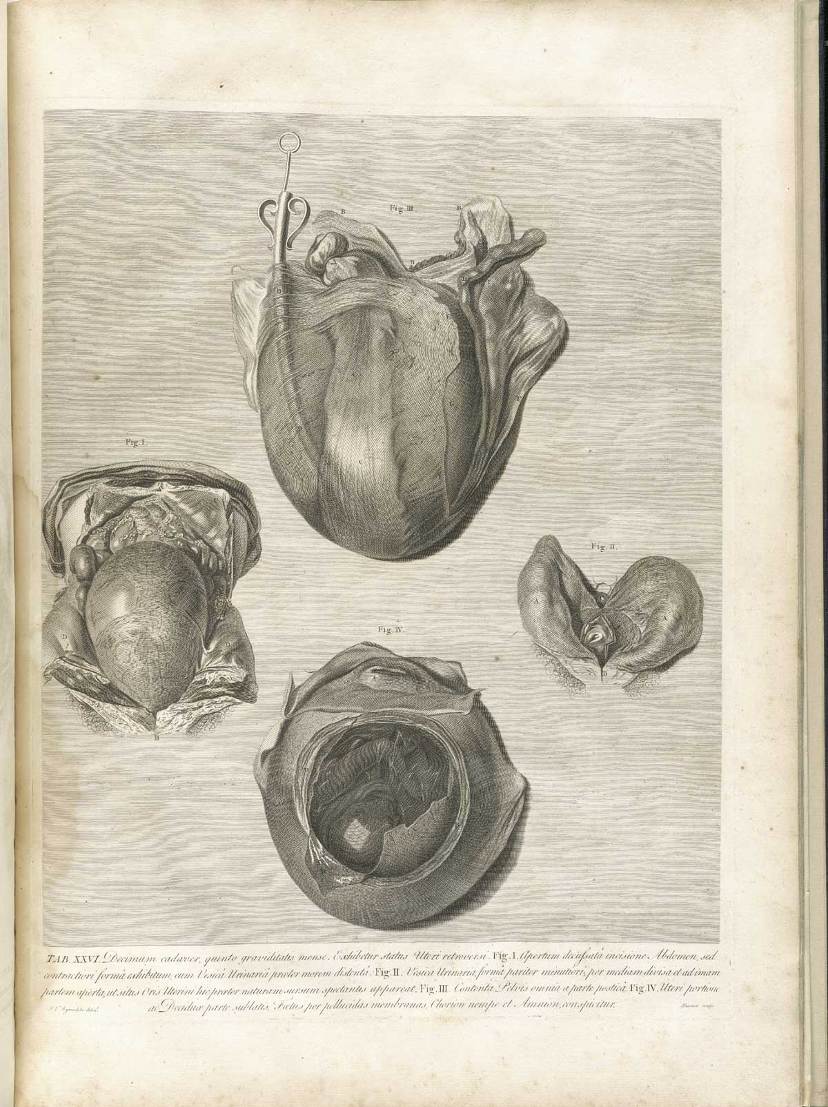 Table 26 of William Hunter's Anatomia uteri humani gravidi tabulis illustrata, featuring four anatomical views of a gravid uterus.