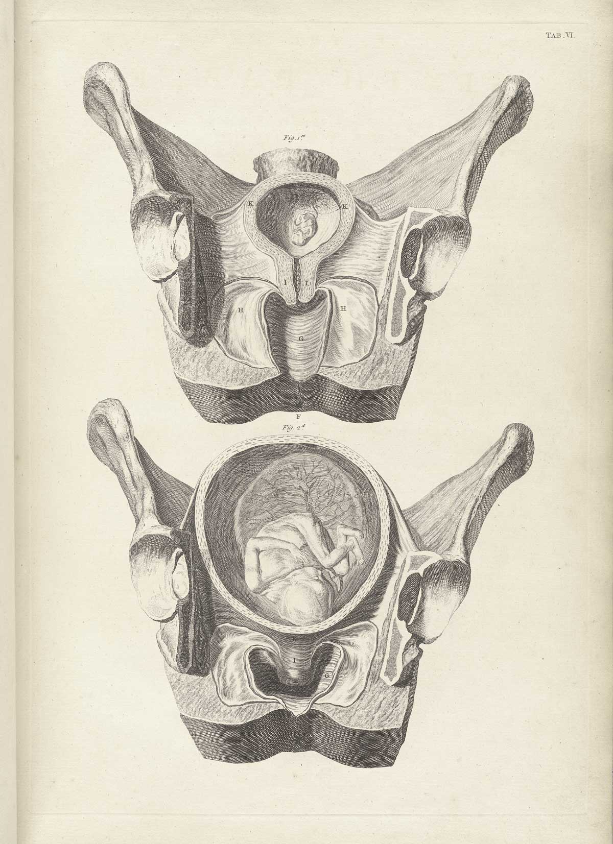 Table 6 of William Smellie's A sett of anatomical tables, with explanations, and an abridgment, of the practice of midwifery, featuring the two illustrated drawings of a woman's pelvis and uterus with a fetus in two stages of growth.