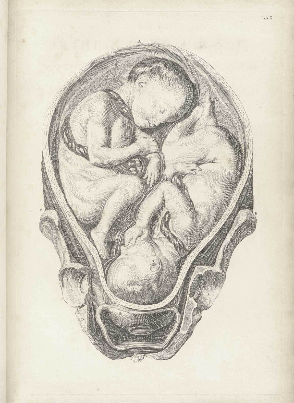 Table 10 of William Smellie's A sett of anatomical tables, with explanations, and an abridgment, of the practice of midwifery, featuring the illustrated drawing of a woman's pelvis and uterus with twin fetus.