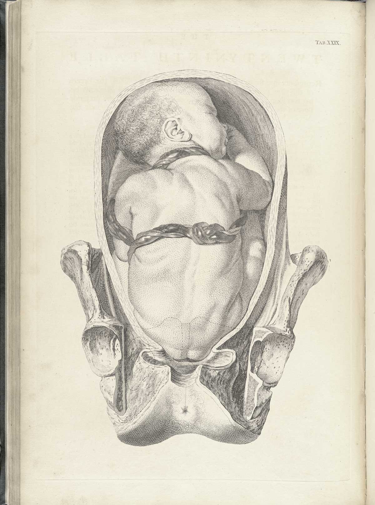 Table 29 of William Smellie's A sett of anatomical tables, with explanations, and an abridgment, of the practice of midwifery, featuring the illustrated drawing of a woman's uterus with a fetus resting in breech position and the imbilical cord wrapped around its back and neck.