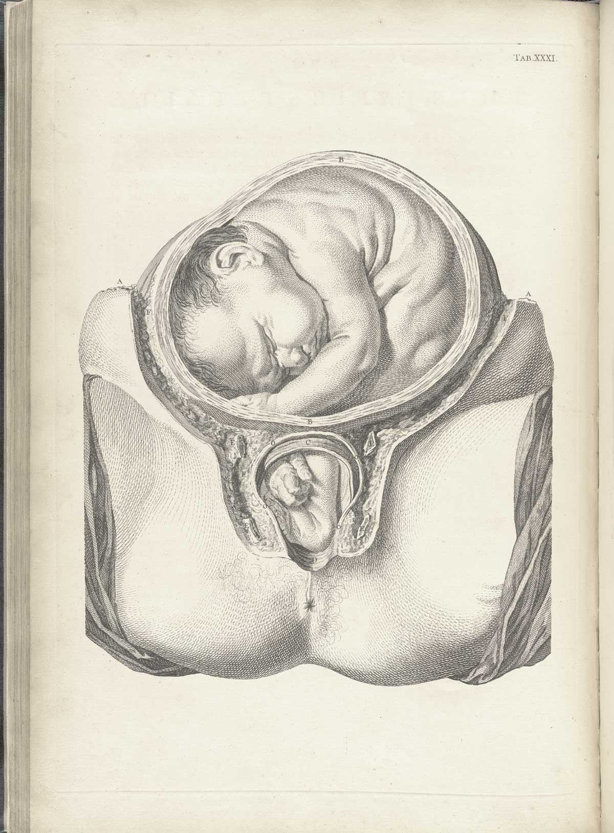 Table 31 of William Smellie's A sett of anatomical tables, with explanations, and an abridgment, of the practice of midwifery, featuring a baby in the uterus with its right hand and left leg crossed in the birthing canal.