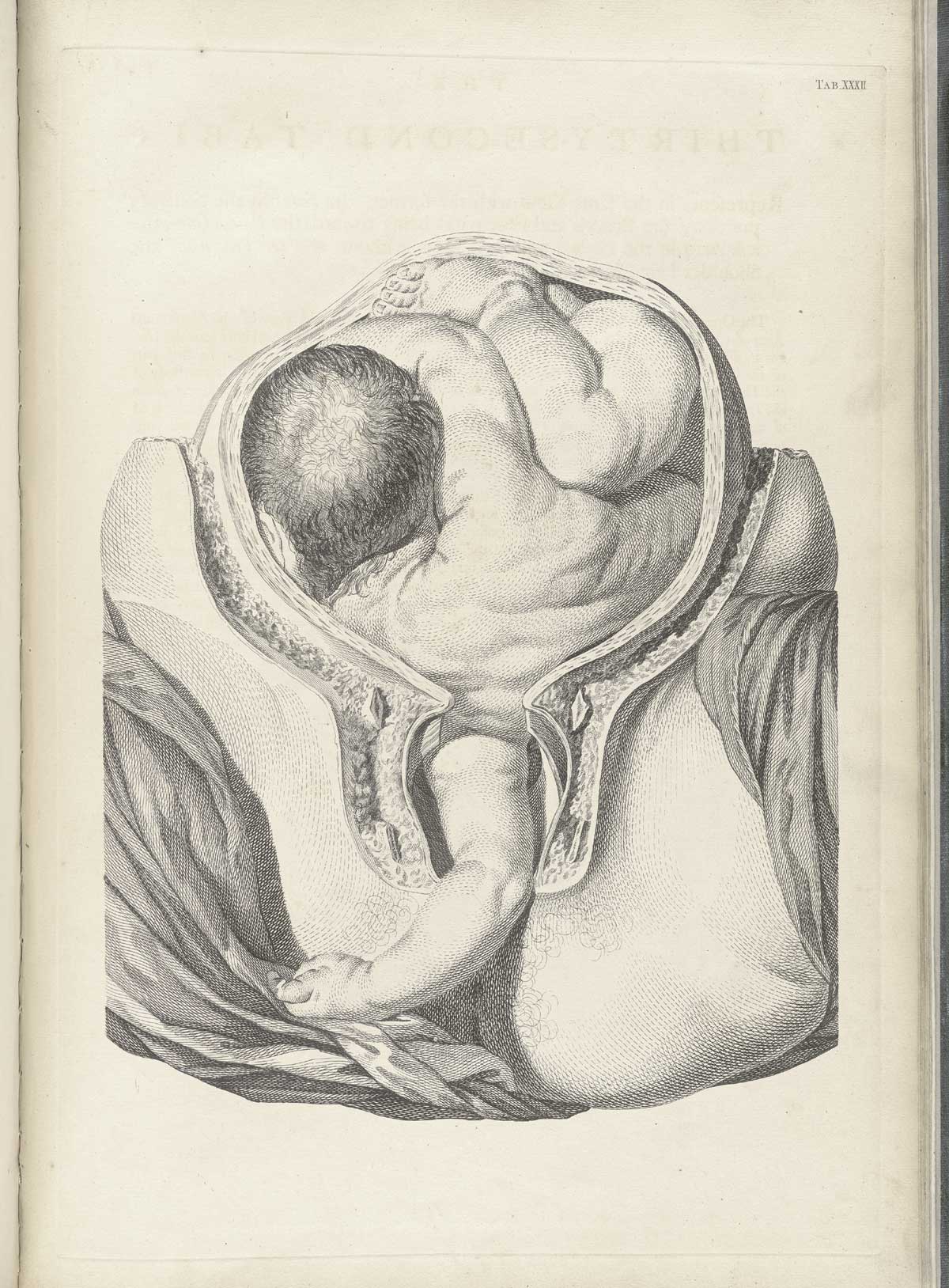 Table 32 of William Smellie's A sett of anatomical tables, with explanations, and an abridgment, of the practice of midwifery, featuring a baby in the uterus with its left arm in the birthing canal.