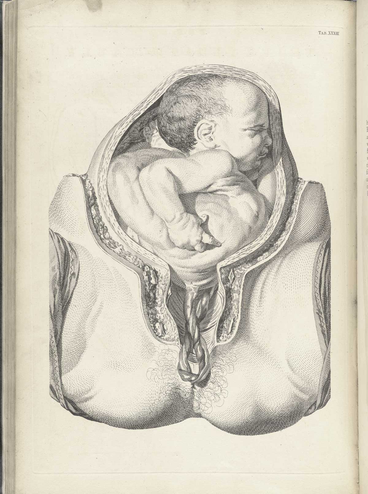 Table 33 of William Smellie's A sett of anatomical tables, with explanations, and an abridgment, of the practice of midwifery, featuring a baby in the uterus stretching backwards, the imbilical cord is in the birth canal.
