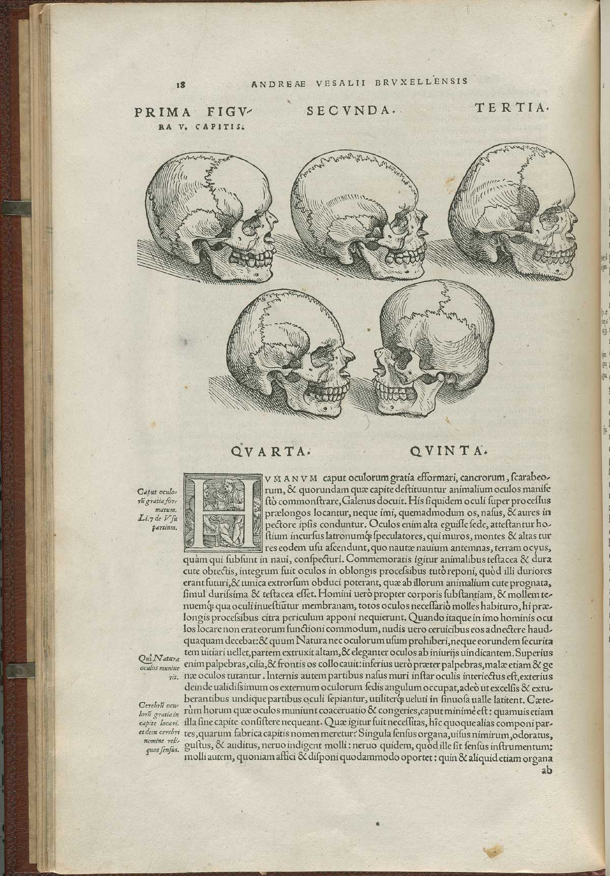 Page 18 of Andreas Vesalius' De corporis humani fabrica libri septem, featuring the five malformations of the skull.