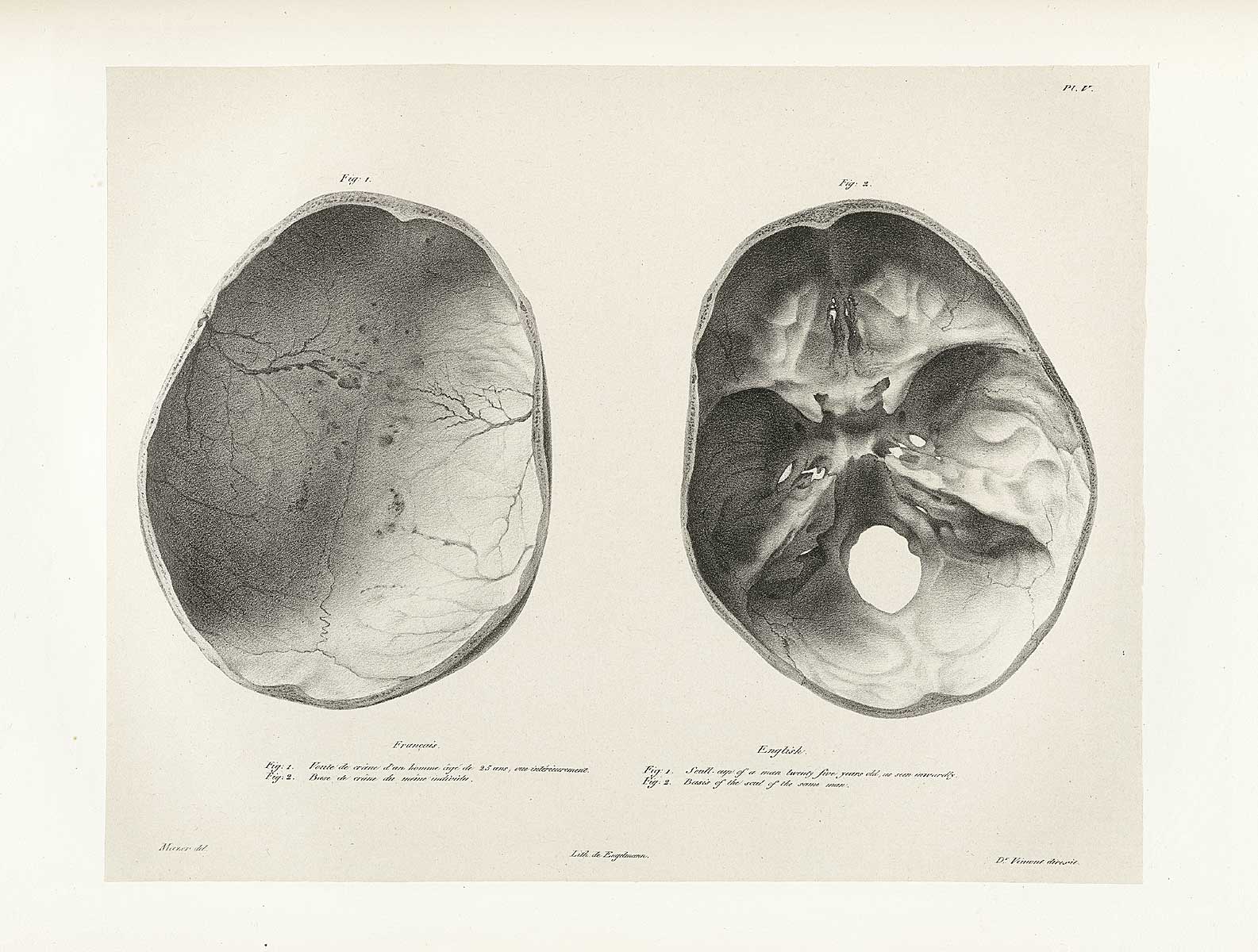 Table 5 of Joseph Vimont's Traité de phrénologie humaine et comparée, featuring two views of the skull cap of a twenty five year old man.