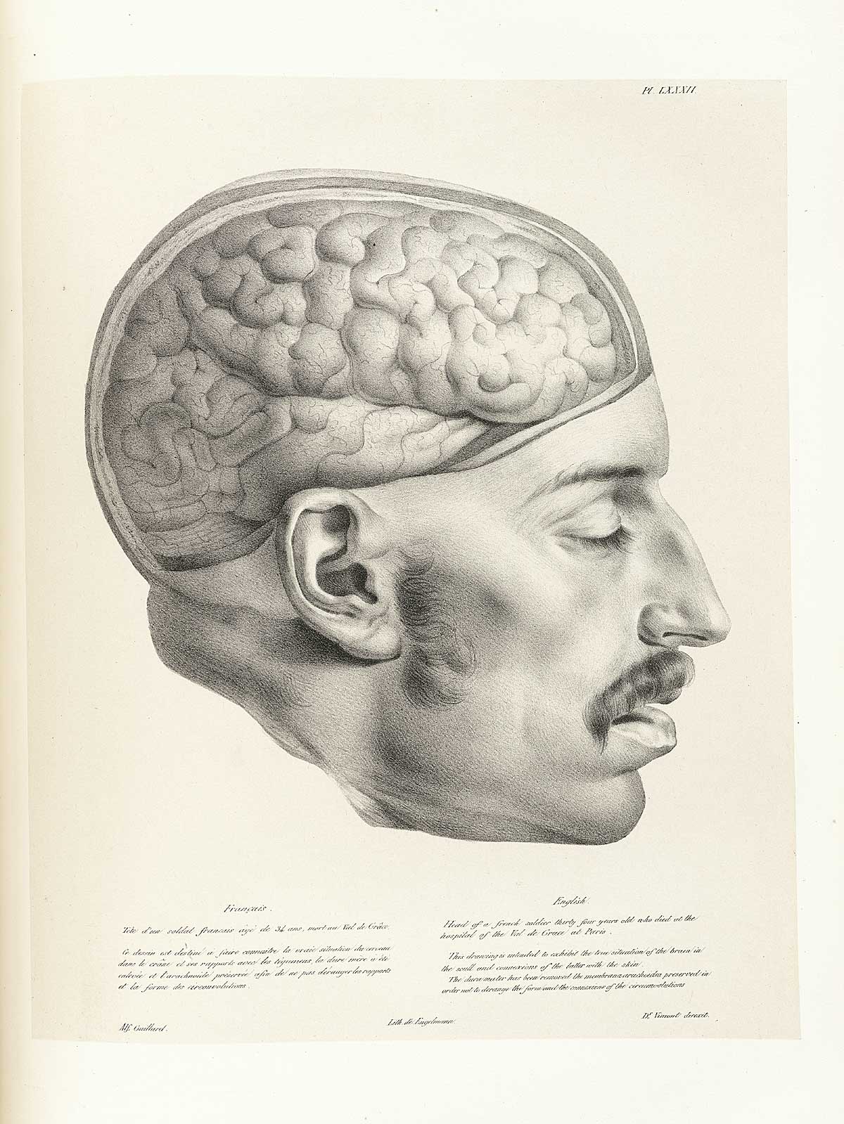 Table 82 of Joseph Vimont's Traité de phrénologie humaine et comparée, featuring the side view of a the head of a French solider, with the dura mater removed.