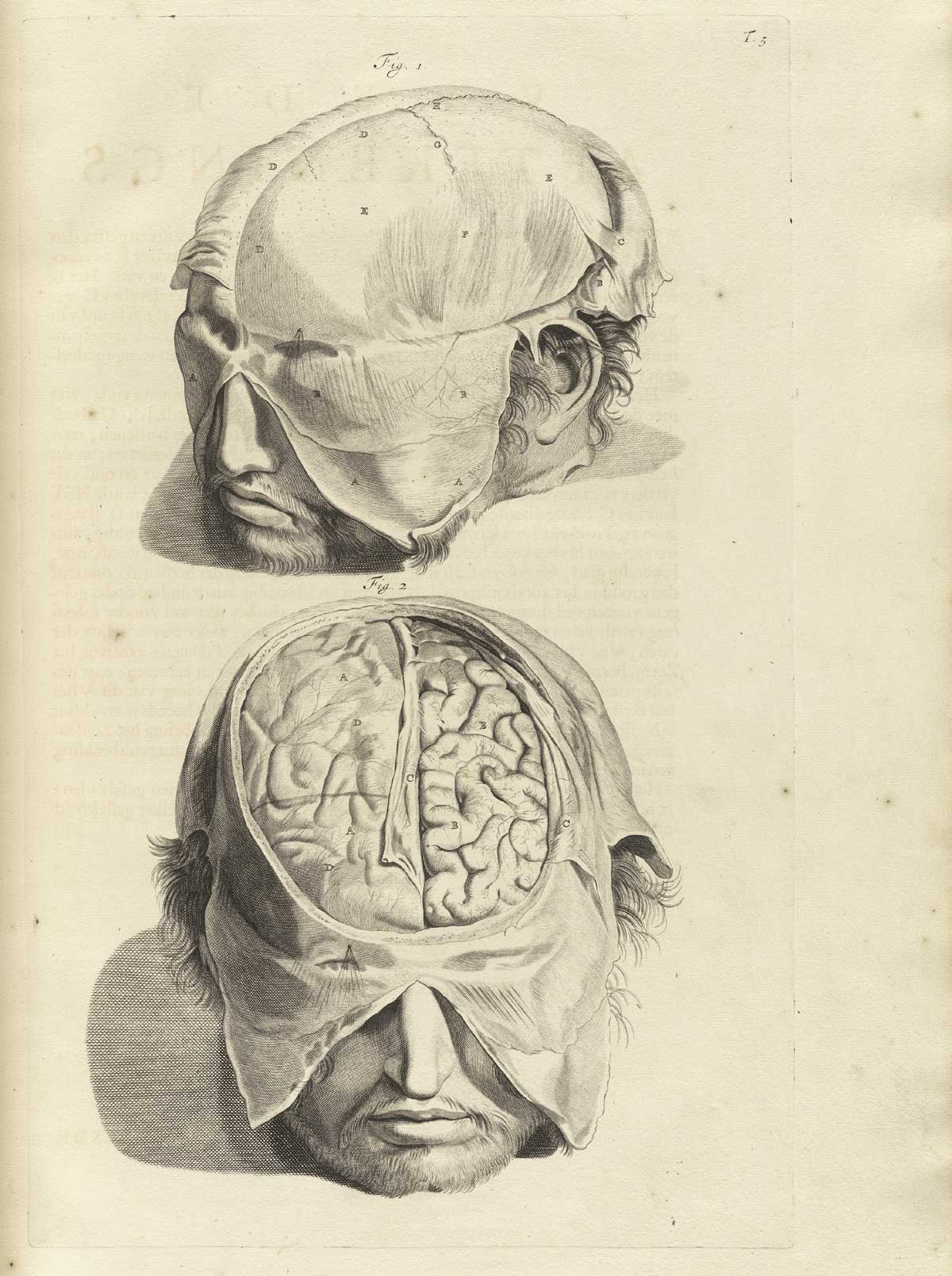 Engraving of two images of male heads with the skull and brain exposed; the top image shows the scalp peeled away from the skull to show muscles of the head and sutures; the bottom image shows the skull cut away and cerebral cortex exposed with dura mater peeled back; from Govard Bidloo’s Ontleding Des Menschelyken Lichaams, Amsterdam, 1690, NLM Call no. WZ 250 B5855anDu 1690.