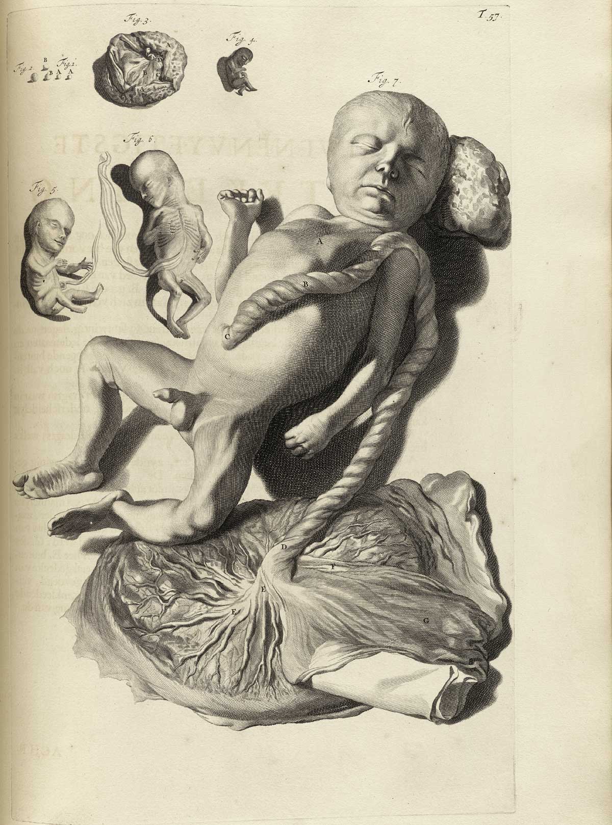 Engraving of four fetuses in various stages of development laying on a dissection table; the largest in the center takes up about three-quarters of the page, a male child laying on its back with a large umbilical cord leading to a fully developed placenta laying at its feet; the other fetuses are small and less developed in the upper left corner, with a small placenta and smaller clusters of cells forming the earliest stages of life; from Govard Bidloo’s Ontleding Des Menschelyken Lichaams, Amsterdam, 1690, NLM Call no. WZ 250 B5855anDu 1690.