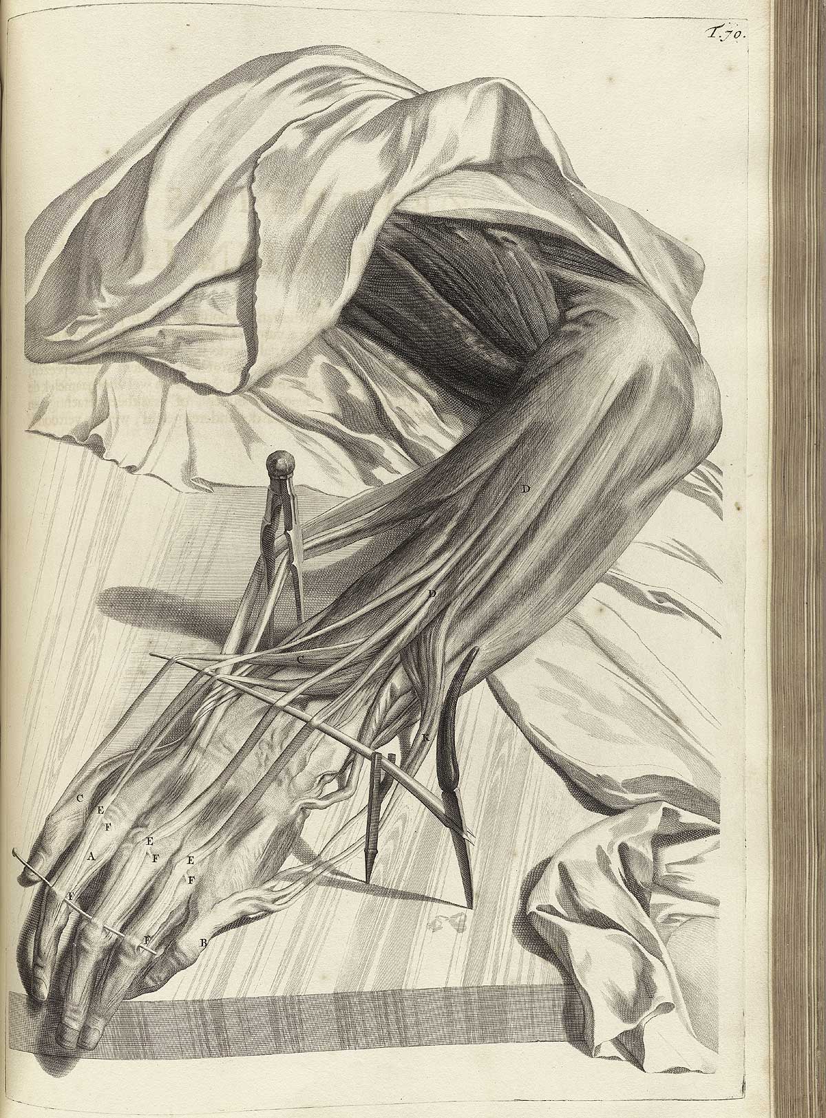 Engraving of a dissected hand with muscles and sinews of the back of the forearm and hand separated with dissecting tools for a detailed view; the forearm and hand are laying in a downward direction and pinned to a wooden board; from Govard Bidloo’s Ontleding Des Menschelyken Lichaams, Amsterdam, 1690, NLM Call no. WZ 250 B5855anDu 1690.
