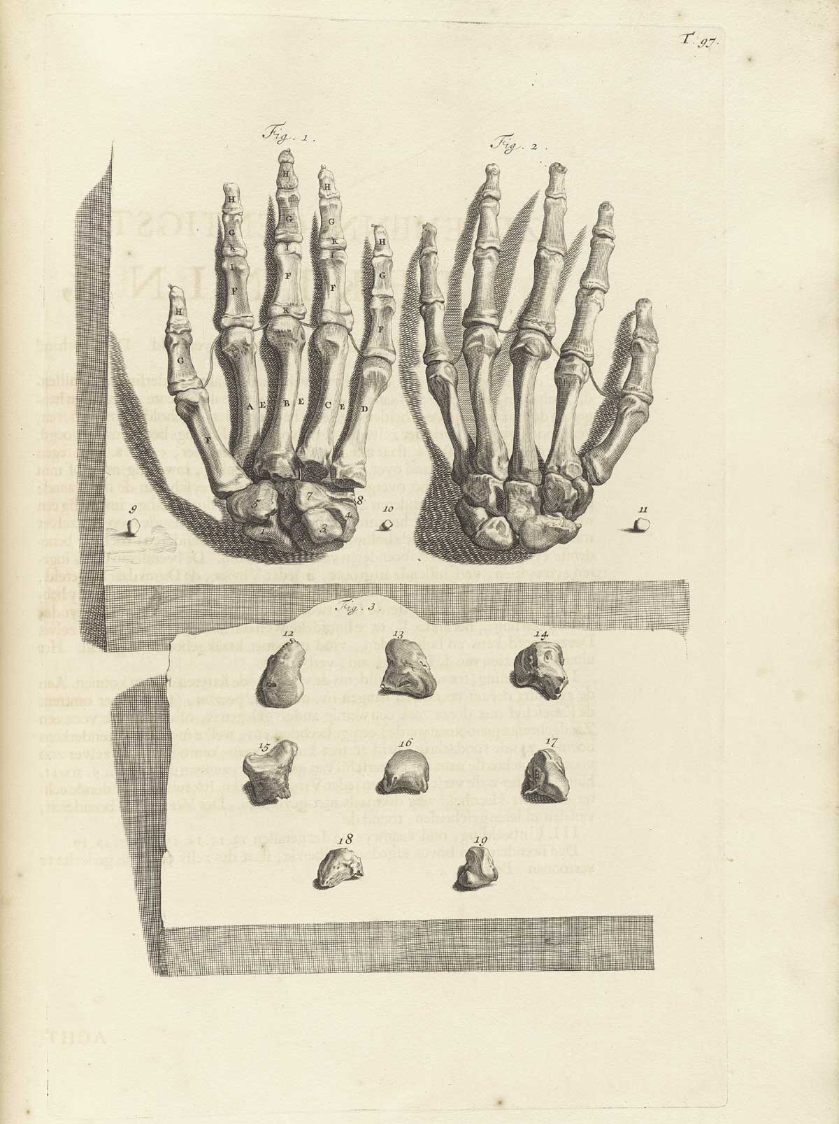 Engraving of the bones of the left and right hands at the top of the page positioned on a wooden board in proper order and attached with string; in the lower have of the image are eight smaller bones of the hand laid out on a wooden board; from Govard Bidloo’s Ontleding Des Menschelyken Lichaams, Amsterdam, 1690, NLM Call no. WZ 250 B5855anDu 1690.